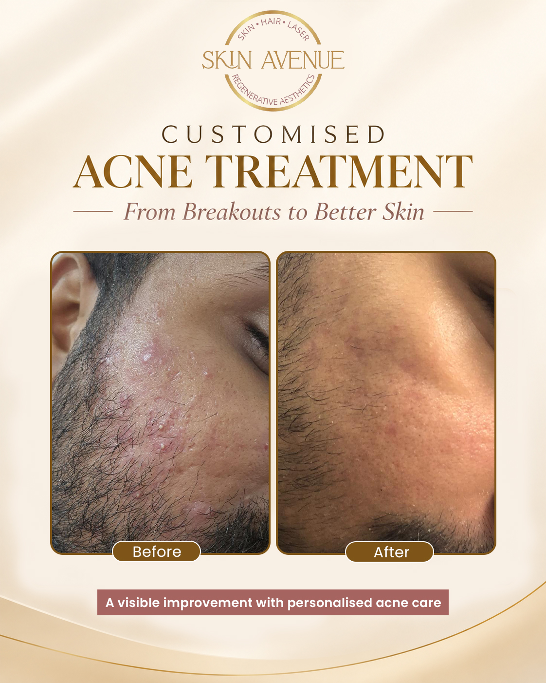 Customised Acne Treatment — before and after