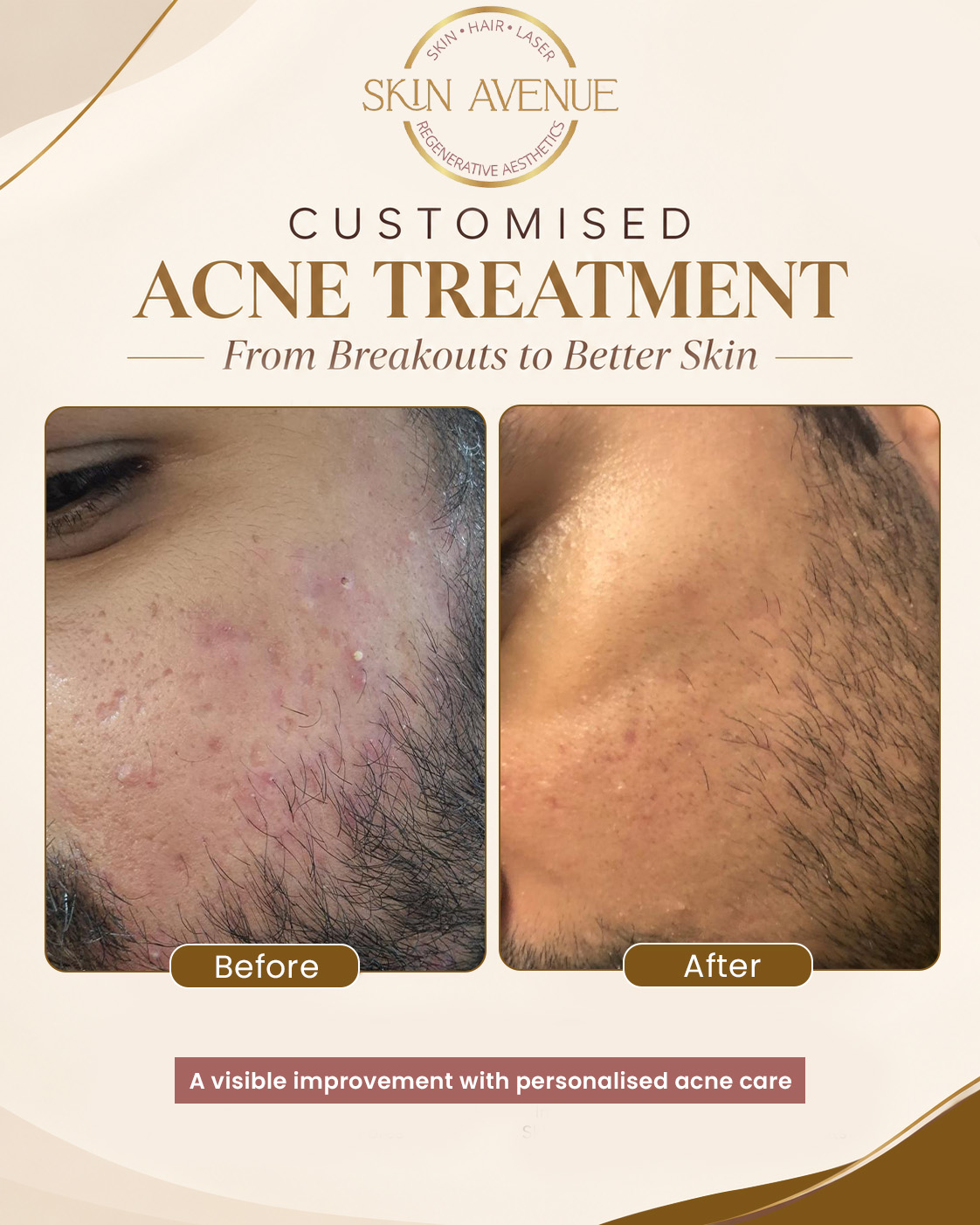 Customised Acne Treatment — before and after