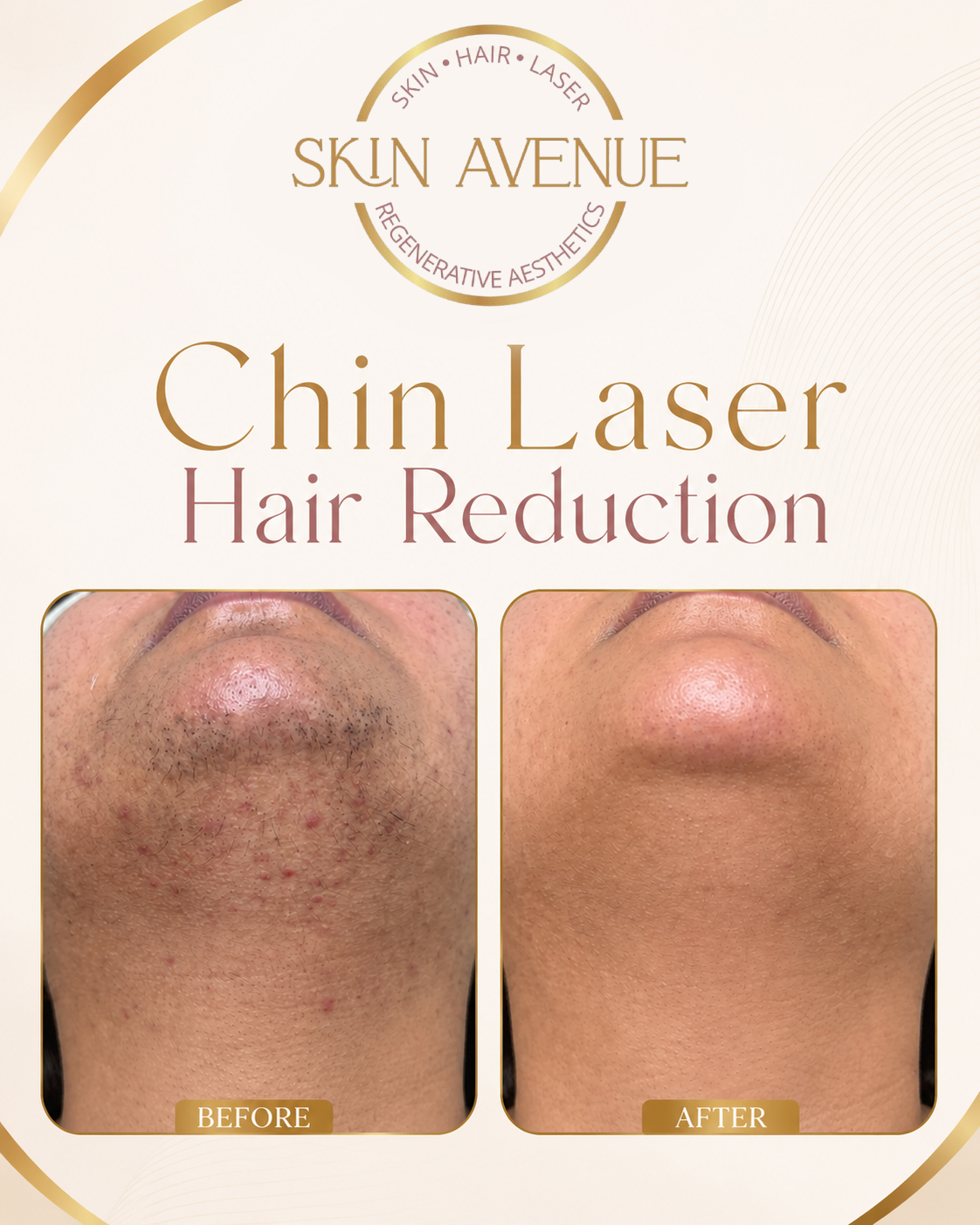 Chin Laser Hair Reduction — before and after