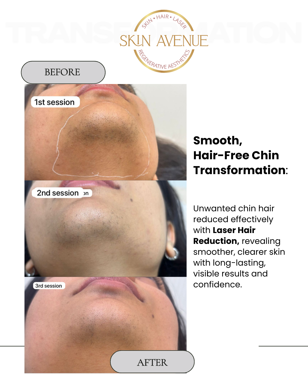 Hair-Free Chin Transformation — before and after