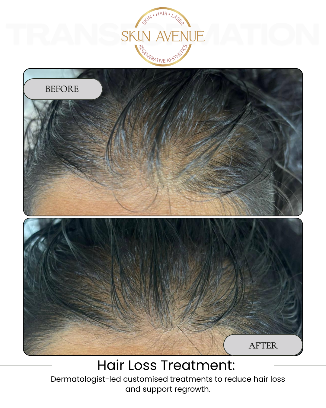 Hair Loss Treatment — before and after