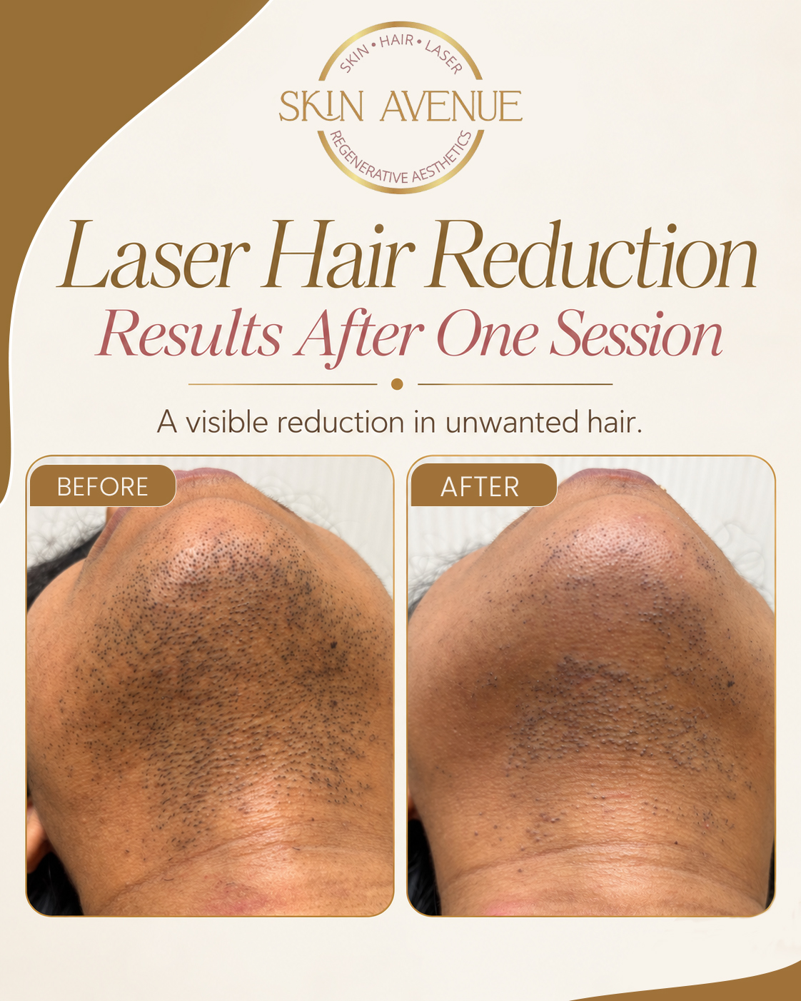 Laser Hair Reduction — After One Session — before and after