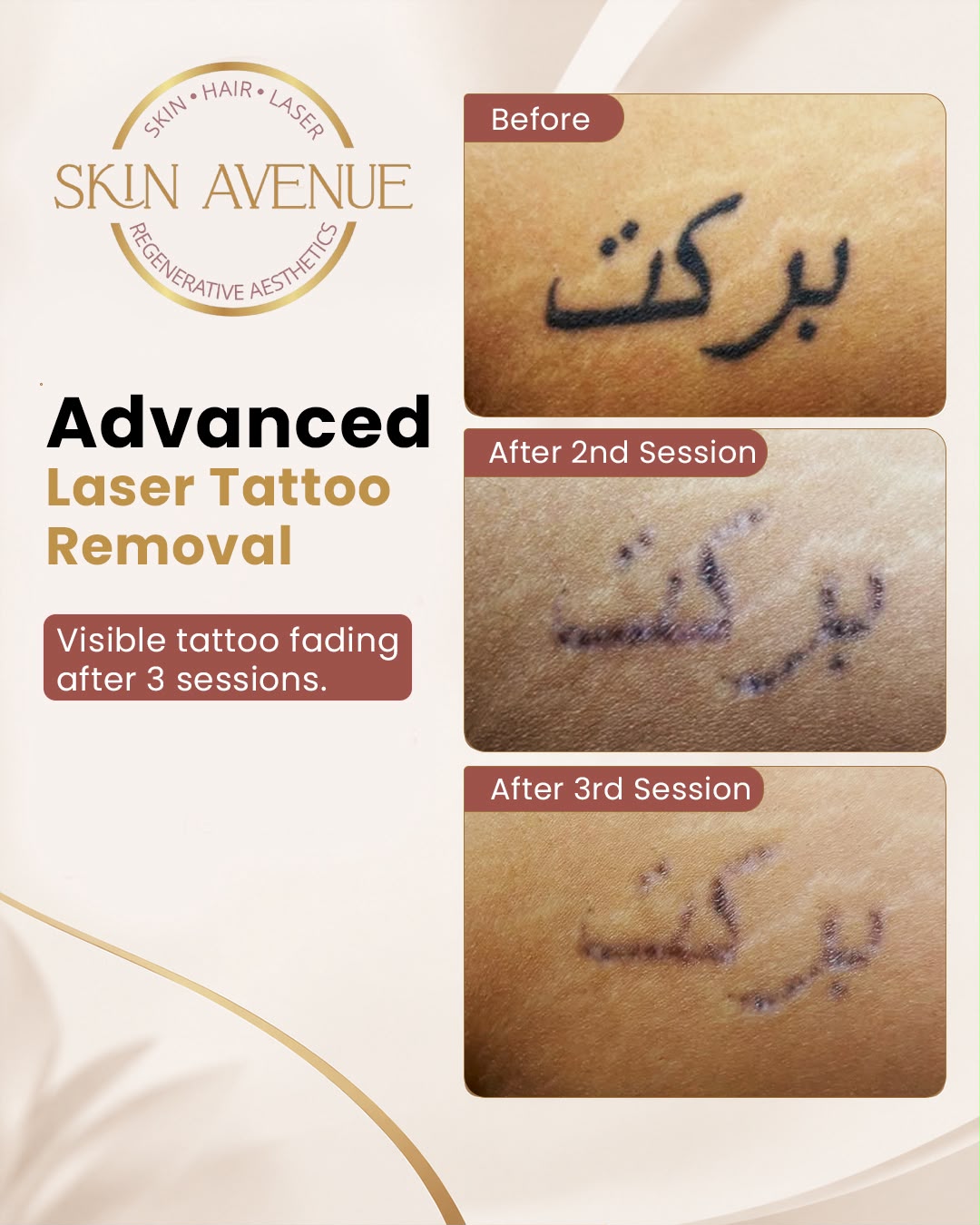 Advanced Laser Tattoo Removal — before and after