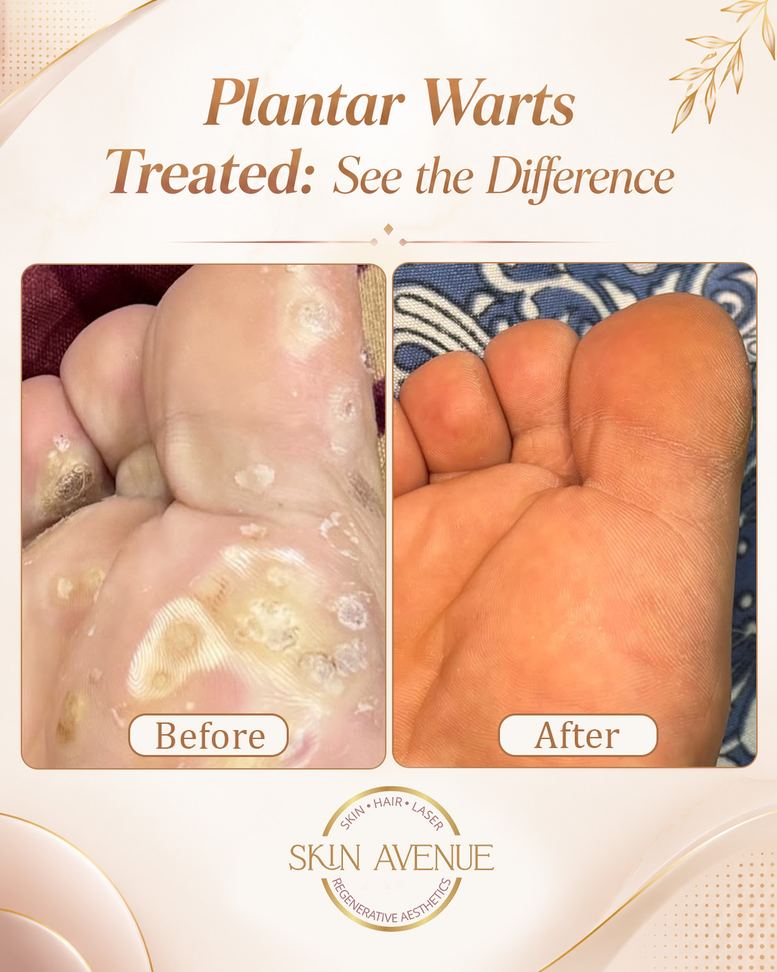 Plantar Warts Treatment — before and after