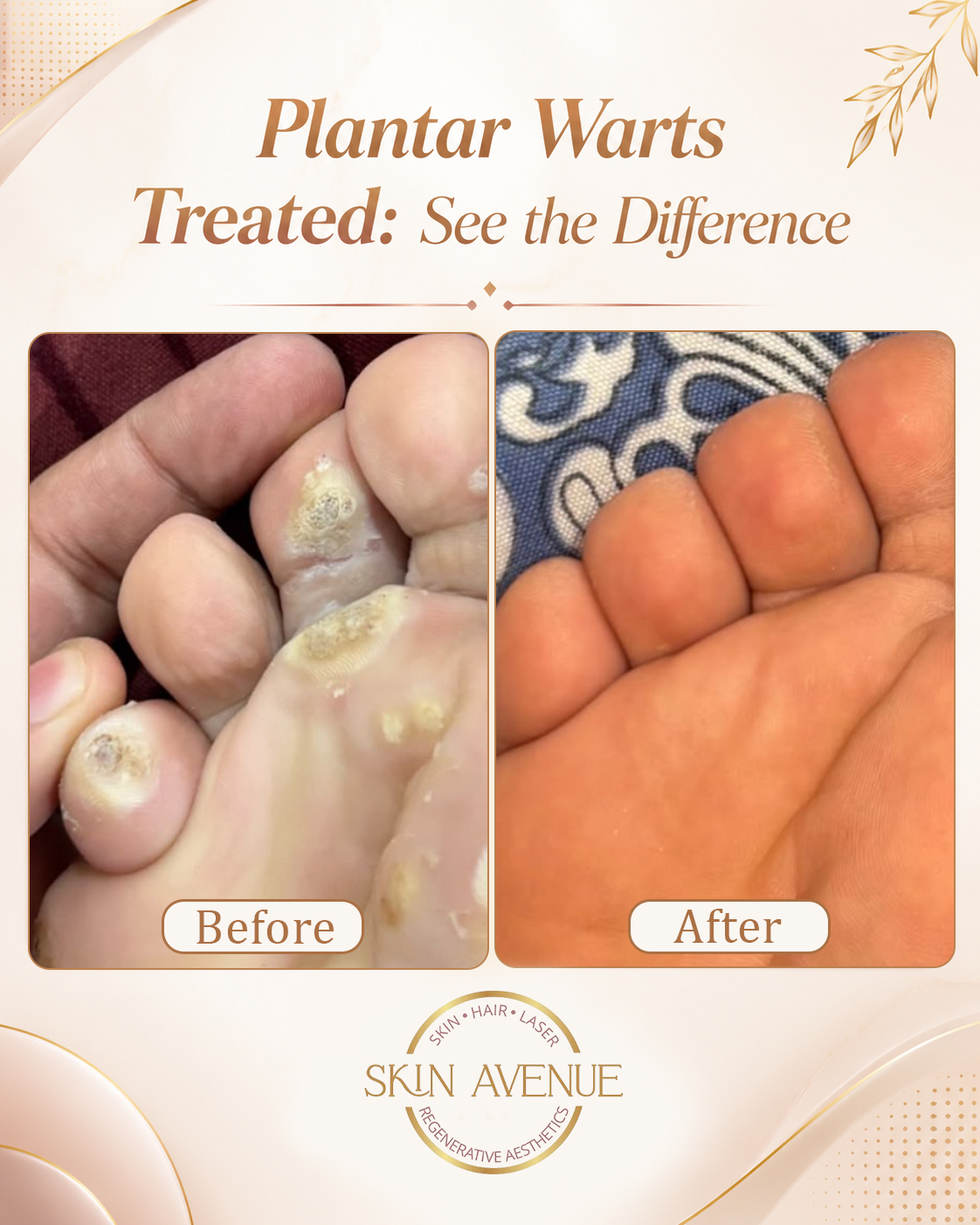 Plantar Warts Treatment — before and after