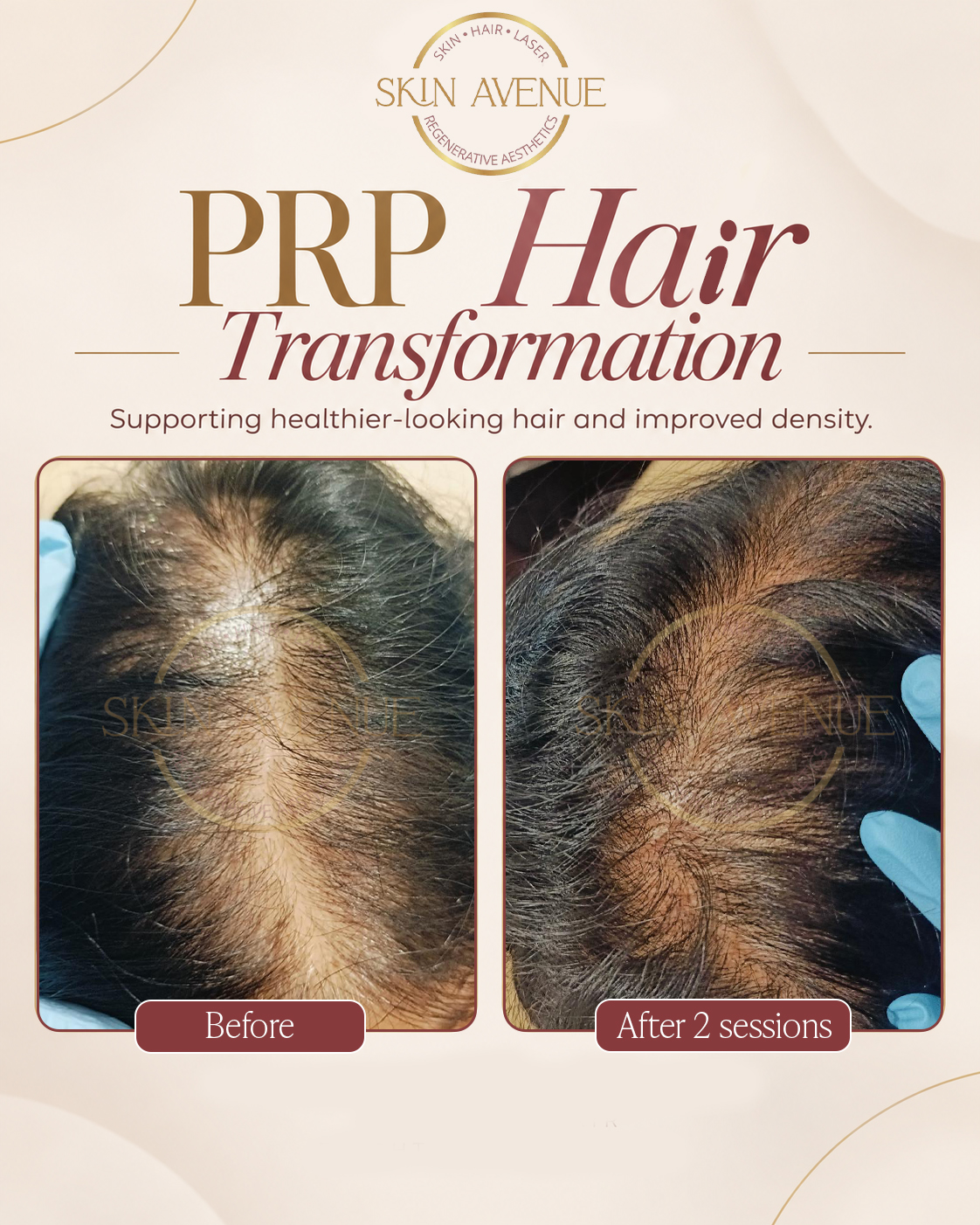PRP Hair Transformation — before and after