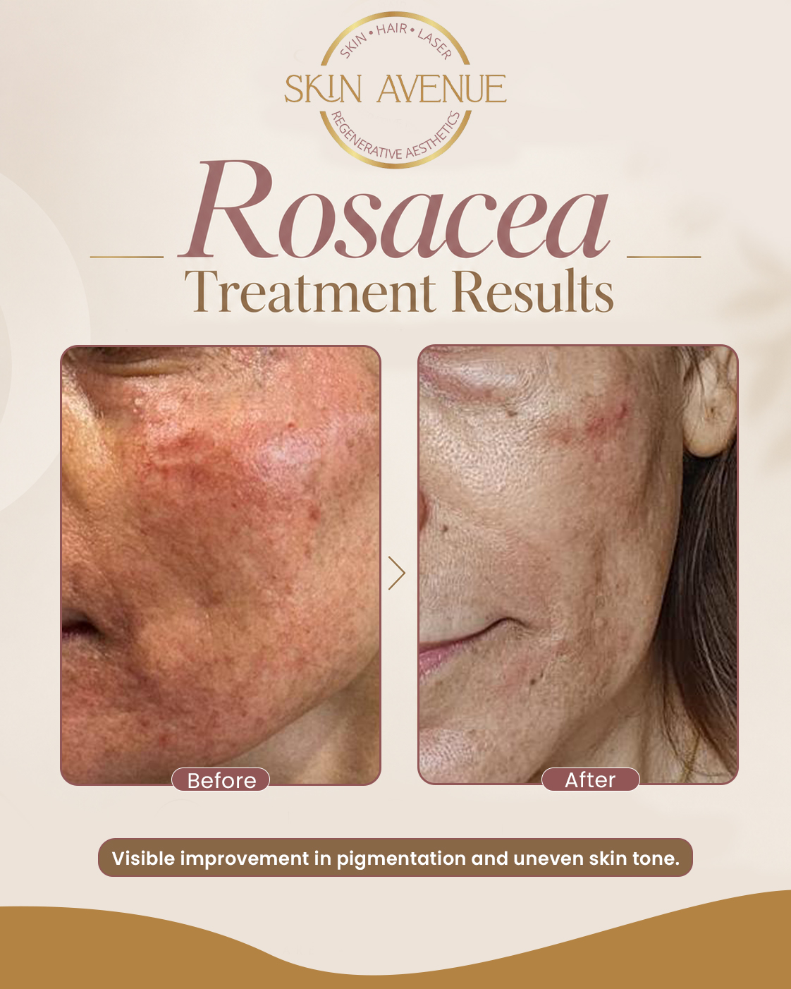 Rosacea Treatment — before and after