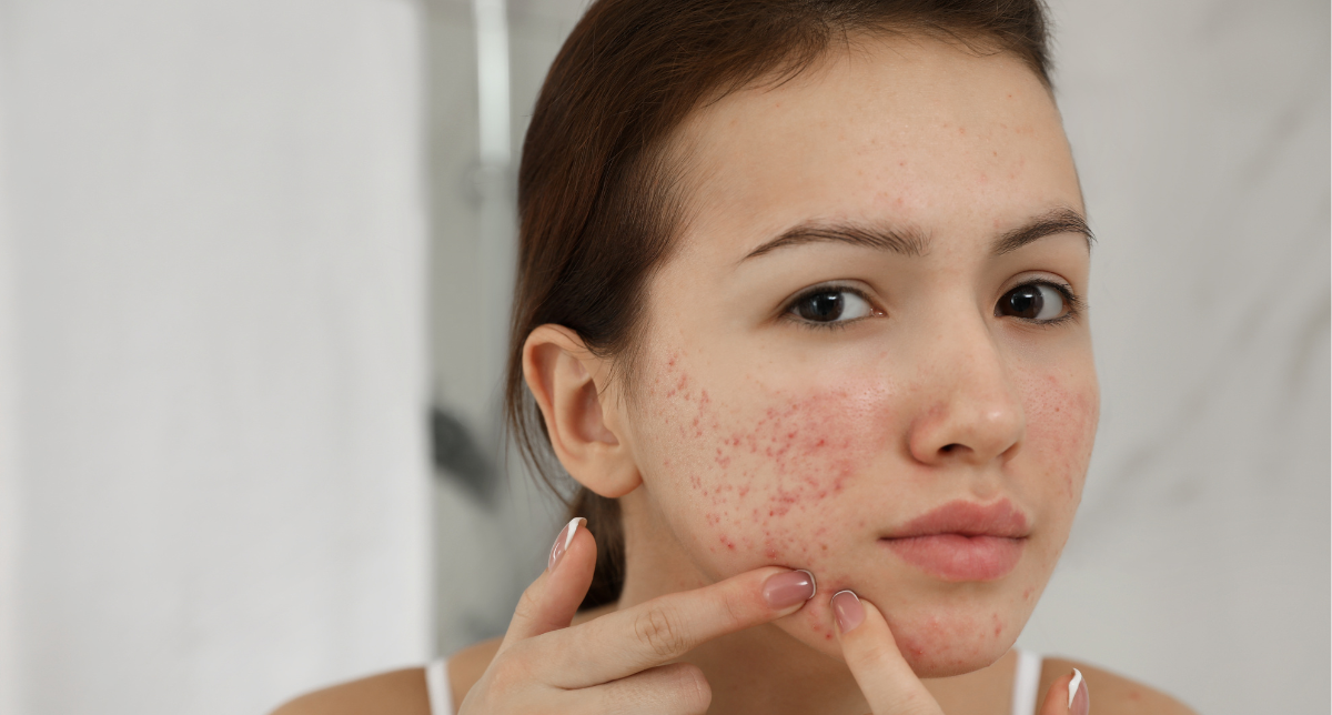 Acne Treatments