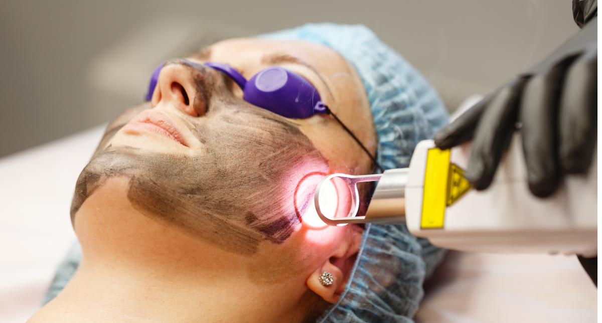 Acne Laser Treatment