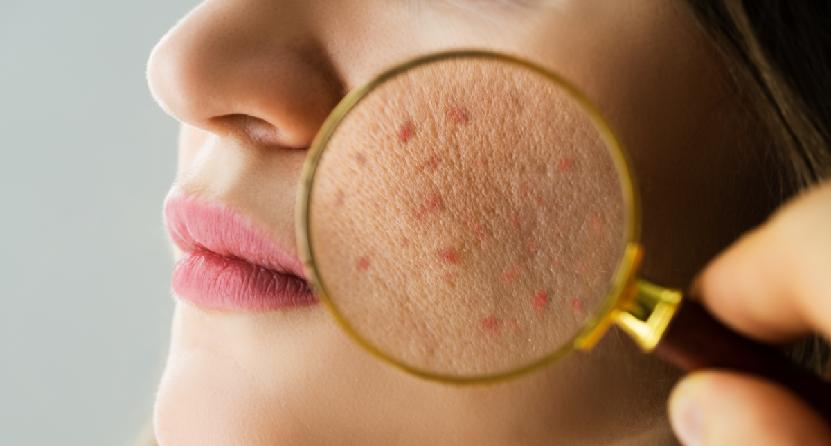 Acne Mark & Pigmentation Treatment