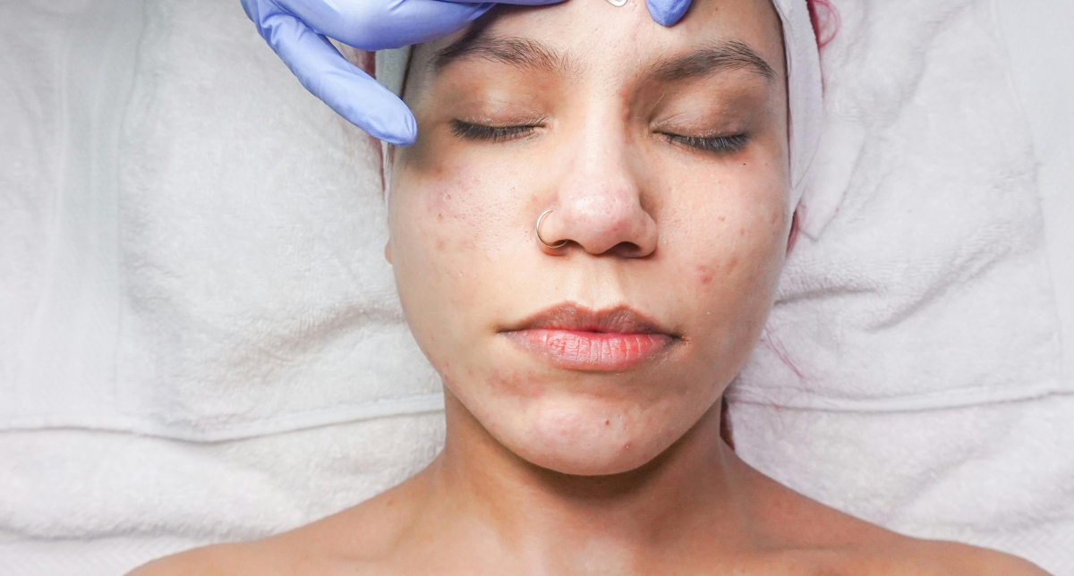 Acne Scar Treatment