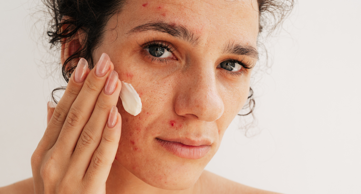Customised Acne Treatment Programme