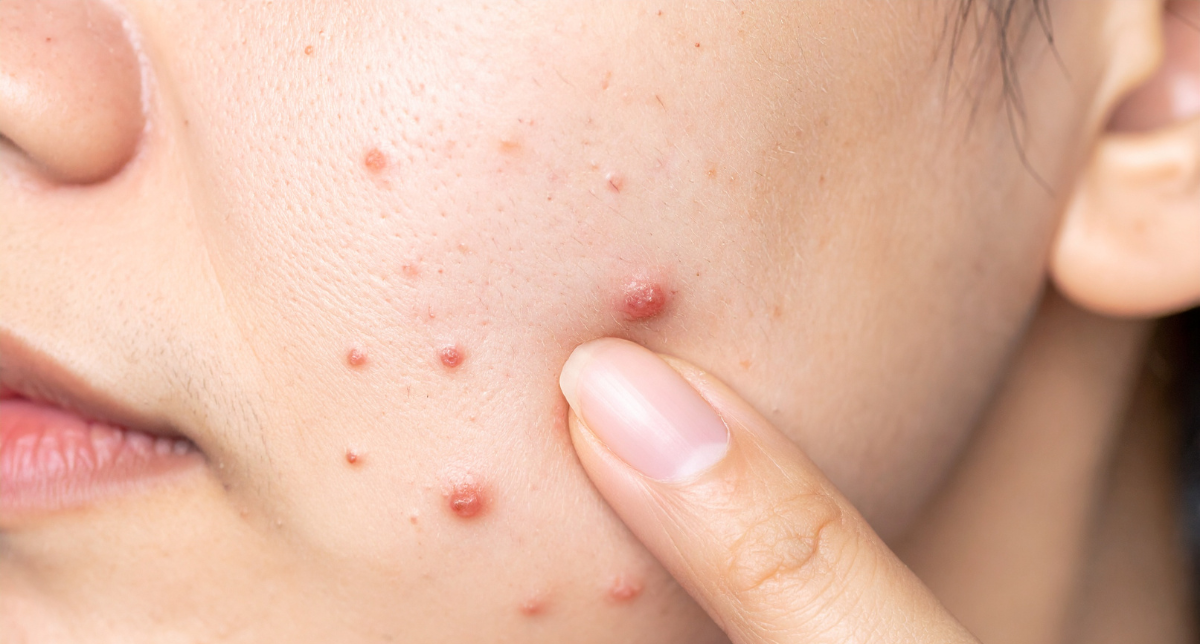 Medical Acne Treatment