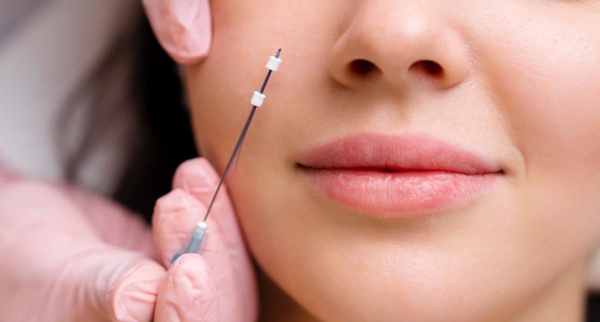 Thread Lift