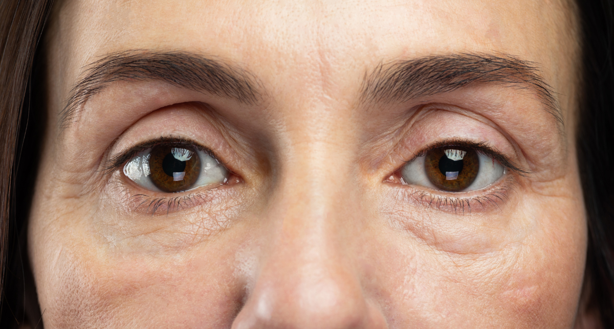 Under-Eye Rejuvenation
