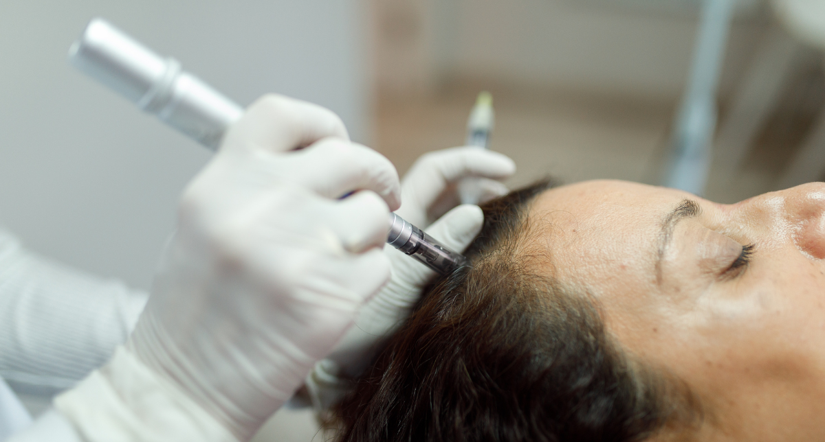 Microneedling for Hair