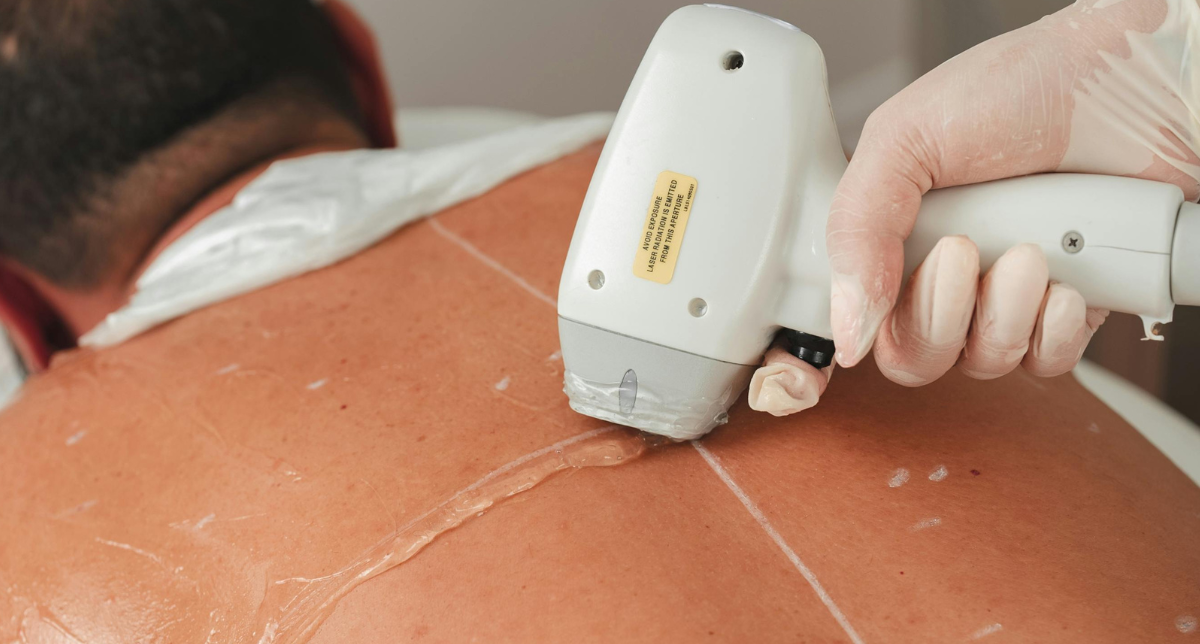 Customised Laser Hair Reduction