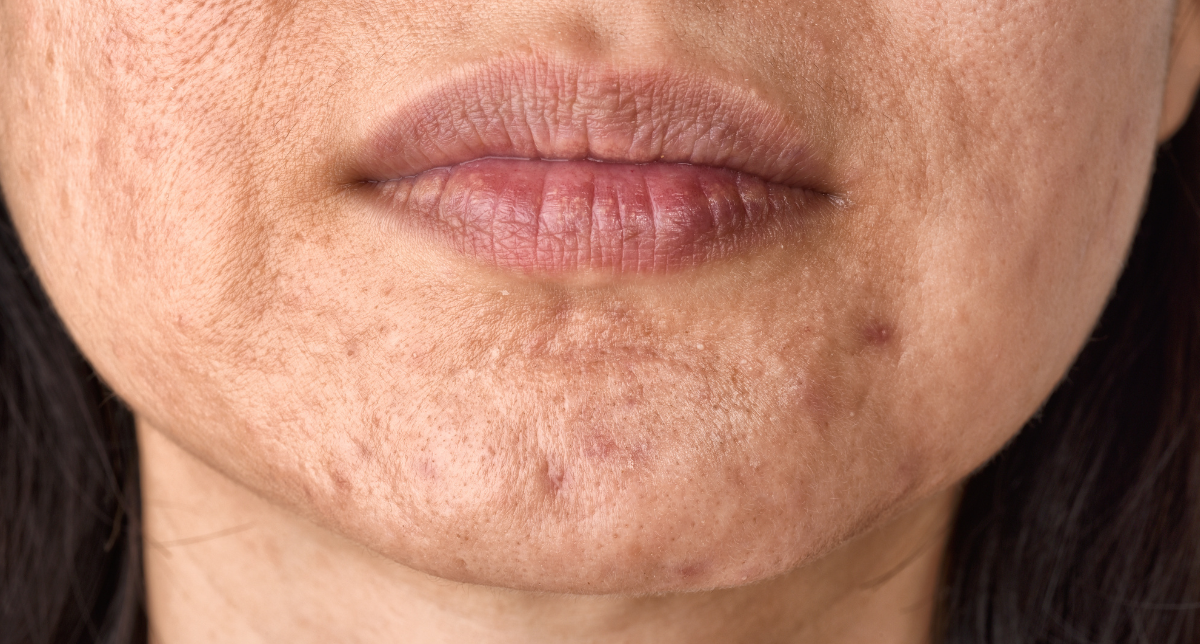 Acne Scar Treatments