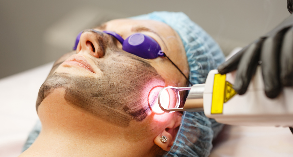 Carbon Laser Toning