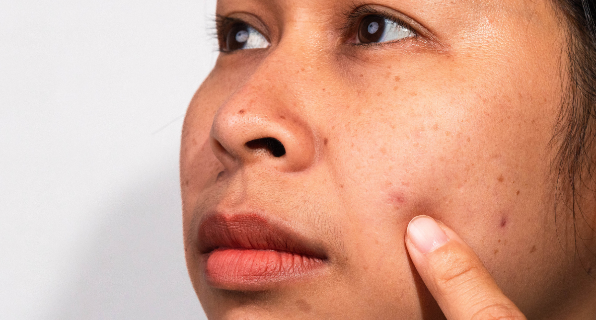 Customised Laser Treatment