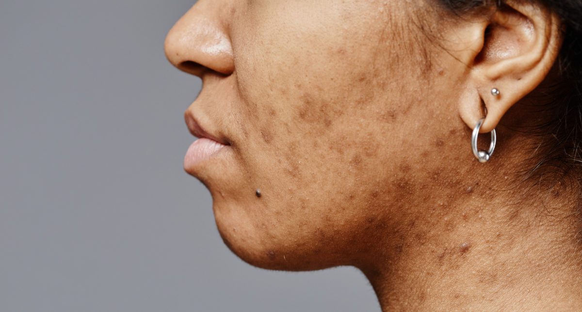 Pigmentation Laser