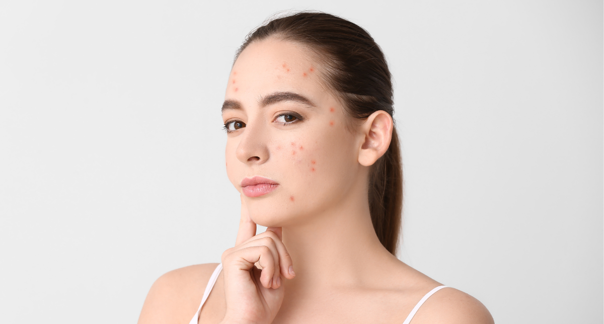 Acne & Acne Mark Treatment
