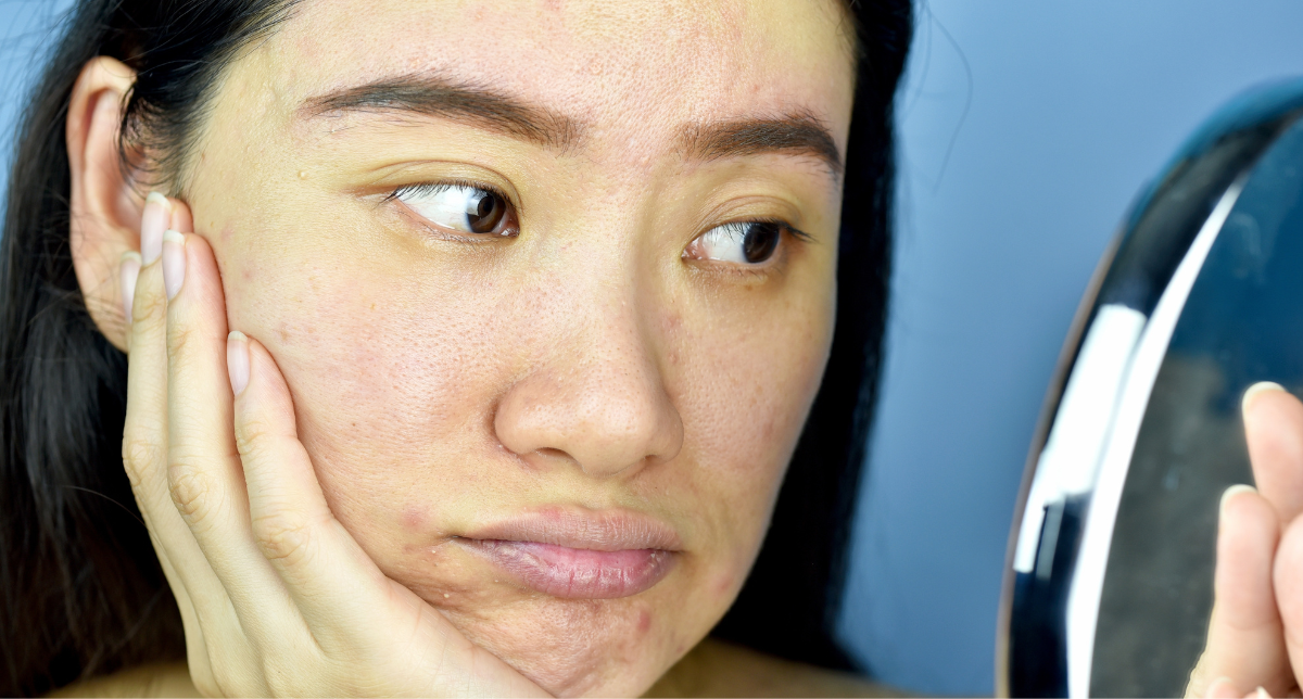 PRP Therapy