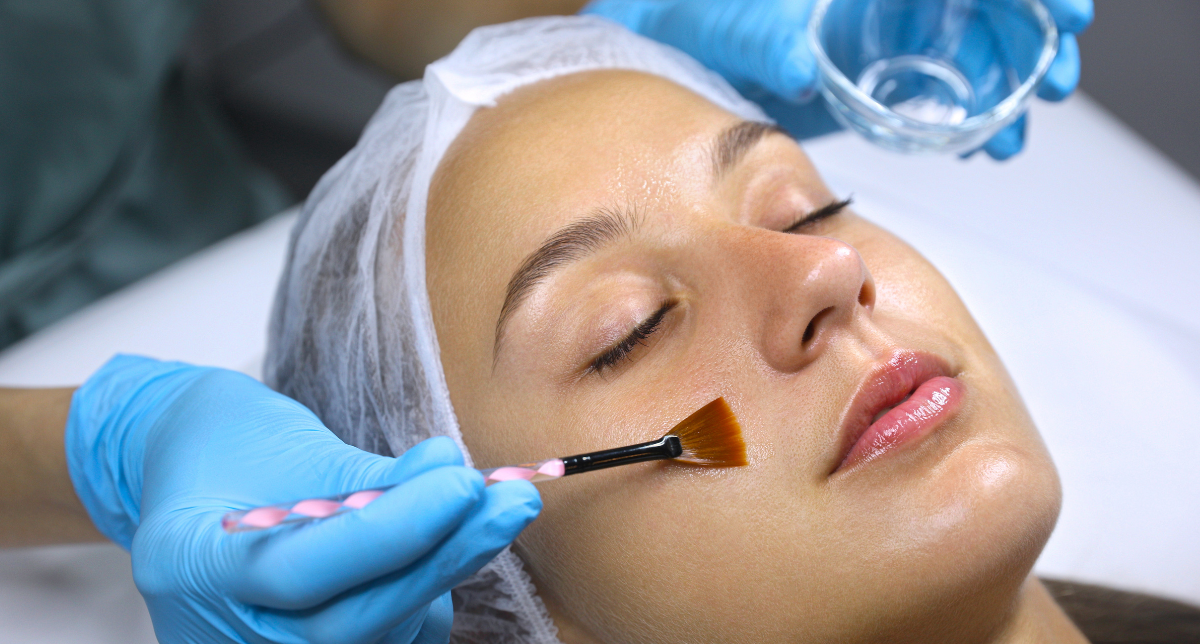 Chemical Peels